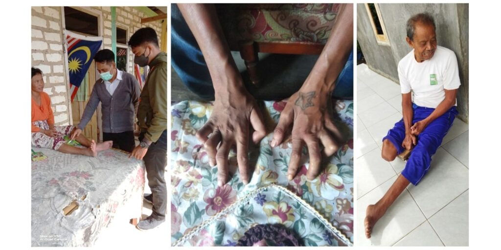Leprosy is not extinct - but it is treatable when detected early